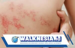 Mengapa Wanita Lebih Rentan Terkena Cacar Api? Ini Penjelasannya