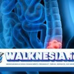 Apa Itu Kanker Kolorektal? Ini Gejala, Penyebab, dan Cara Mencegahnya