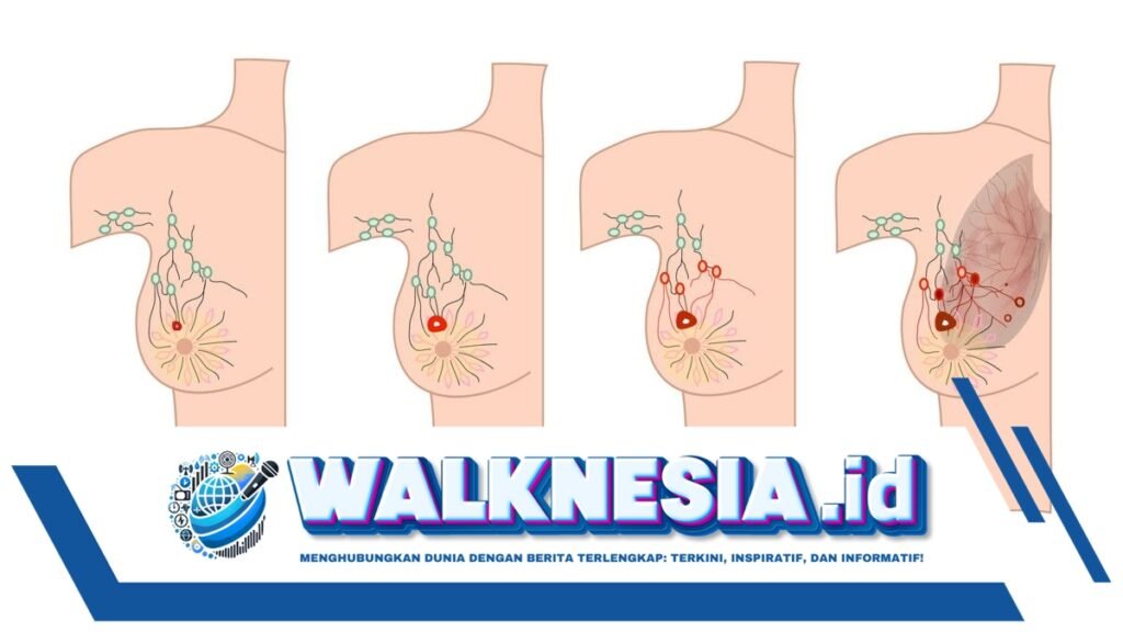 Tanda-Tanda Awal Tumor Payudara yang Perlu Diwaspadai