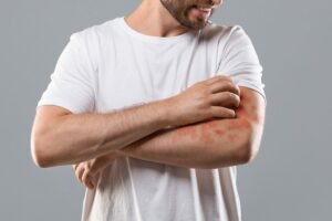 Waspadai Serangan Jamur Kulit! Diabetes dan Obesitas Jadi Faktor Risiko Utama
