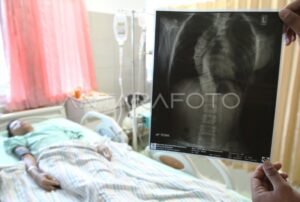 Menjelajahi Horizon Kesehatan: Penyakit Langka di Tahun 2025 dan Tantangan yang Menanti